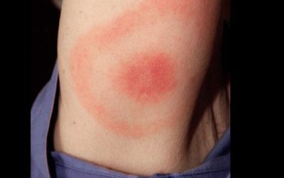 Psychiatrie et maladie de Lyme : des symptômes méconnus de la borréliose