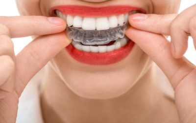 Tout savoir sur la colle dentaire pour dentier et appareil dentaire