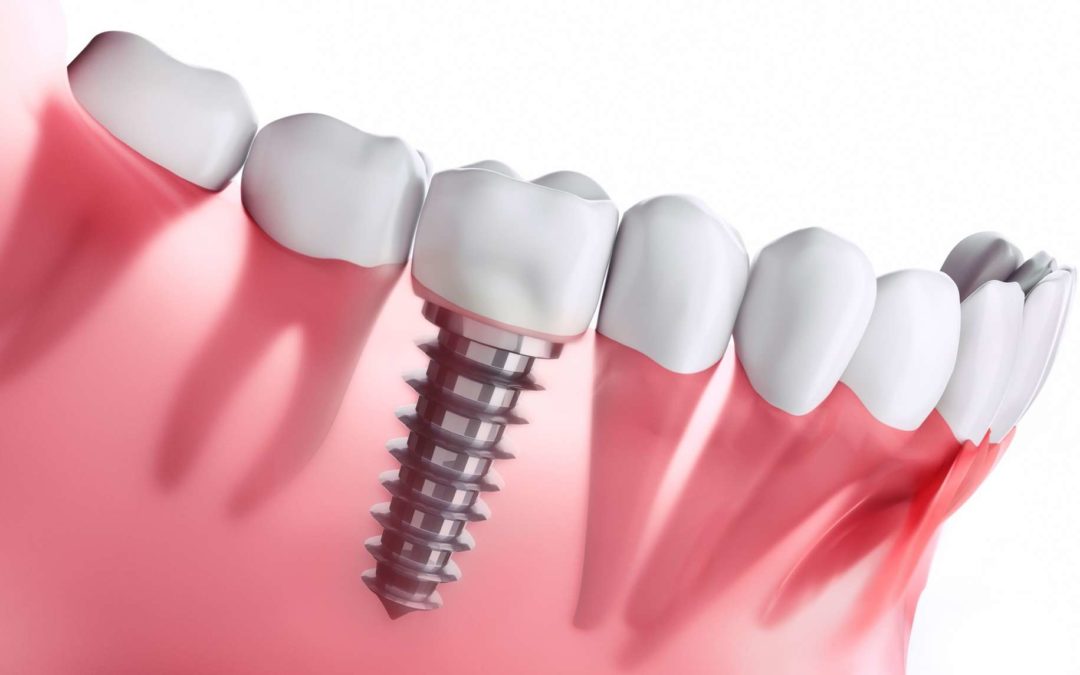 Tout savoir sur les implants dentaires !