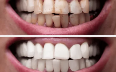 Une astuce simple pour des dents plus blanches selon un dentiste expert