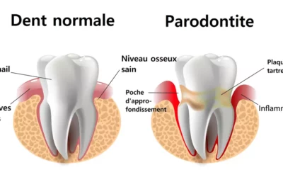 Comprendre la parodontologie : la santé des tissus dentaires sous la loupe