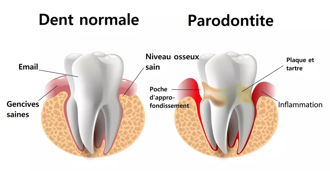 Comprendre la parodontologie : la santé des tissus dentaires sous la loupe