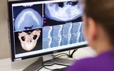 Tout savoir sur le comblement osseux en implantologie dentaire